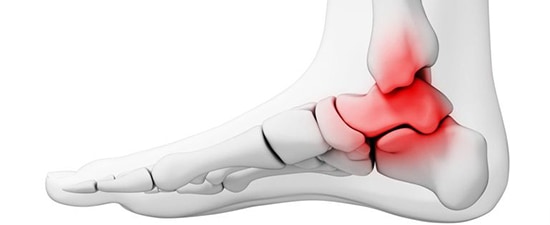Anatomical illustration of a foot highlighting painful areas of ankle arthritis with red markings indicating inflammation.