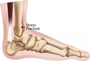 Stress Fracture, Dr. Bob Baravarian, Los Angeles