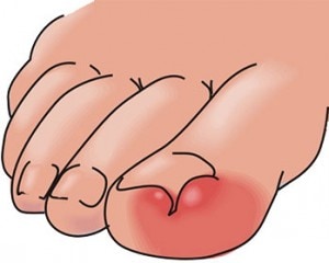 Ingrown toenail treatment
