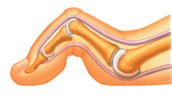Hammertoe Diagram