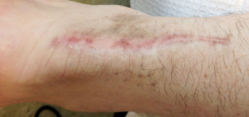 Initial Scar
