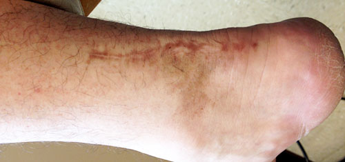 3 weeks after laser treatment #1