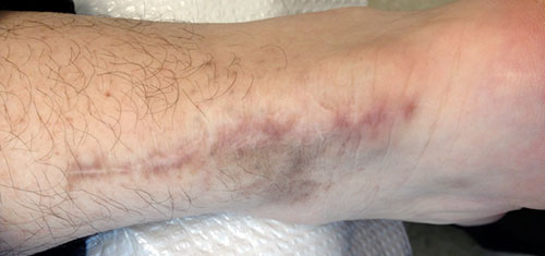 3 weeks after laser treatment #2