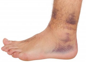 High Ankle Sprain