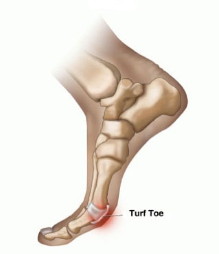 Turf Toe