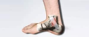 Tarsal Tunnel Syndrome