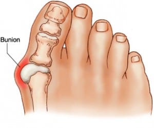 Pregnancy Feet and Bunion Treatment