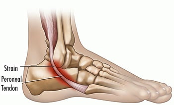Nick young, Ankle strain