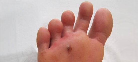 Foot puncture wound on the sole, highlighting a small hole caused by a pointed object, relevant to foot health and walking injuries.