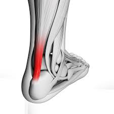 Achilles Tendonitis, Walking Pain
