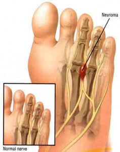 Mortons Neuroma, Walking Pain