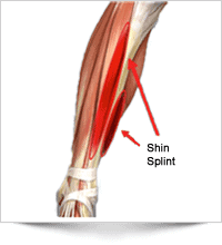 Walking pain, shin splint