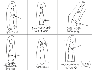 Types of broken and fractured fingers