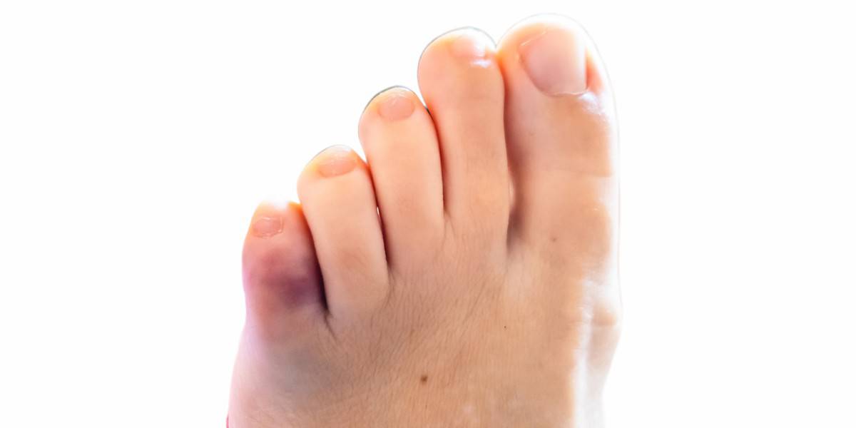 Broken Toes