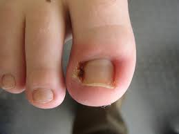 ingrown-toenail