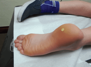 kids-plantar-wart