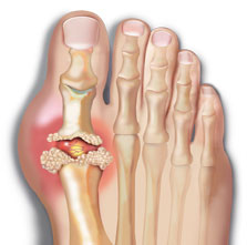 Gout