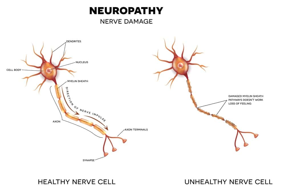 Peripheral Neuropathy diagram compressed