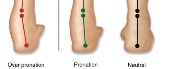 Overpronation symptoms and treatment, Dr. Bob Baravarian Insitute