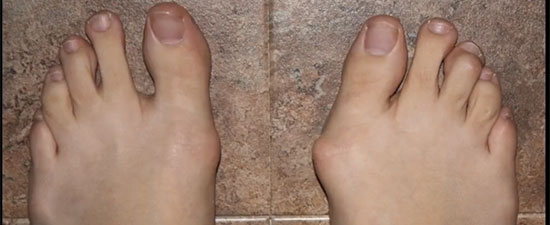 Bunion Myths and Facts -- Dr. Bob Baravarian