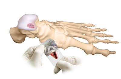 Denovo Cartilage Repair