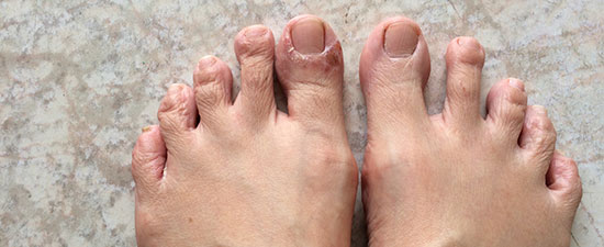 Rash on feet after beach, Hookworms