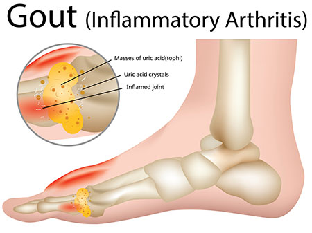 Big toe gout illustration