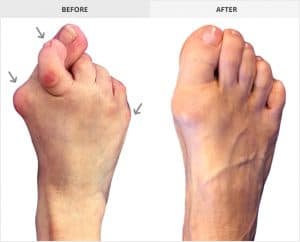 Best Bunion Surgeon, Before and after Bunion surgery pictures
