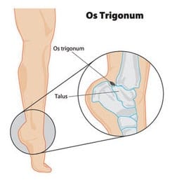 os trigonum