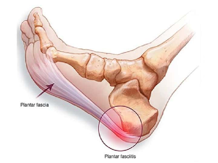 Diagram of Plantar Fasciitis
