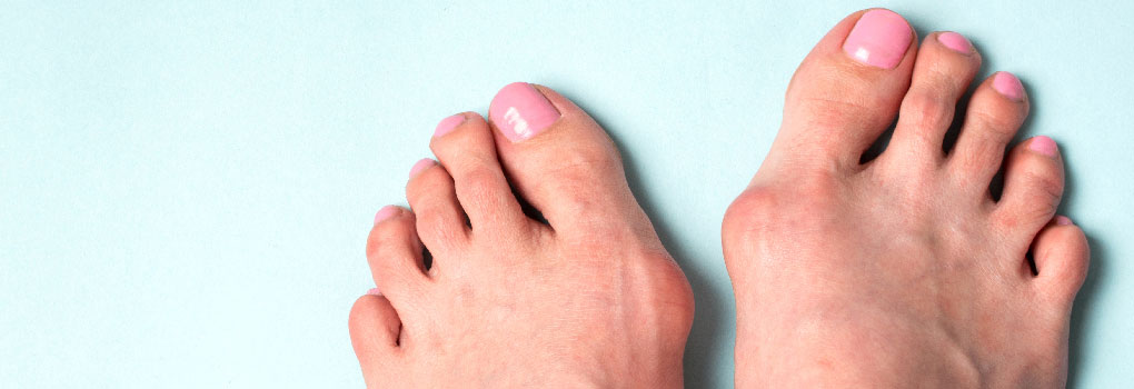 What's a Best Treatment for a Bunion? Not Waiting to See Your Doctor