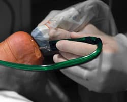 Tenex Procedure for Chronic Plantar fasciitis and Heel Pain