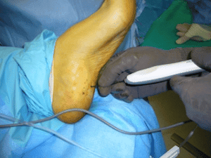 Topaz procedure for plantar fasiitis