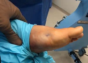Minvasive Bunionectomy Incision