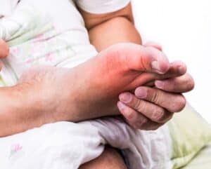 gout and big toe bumps