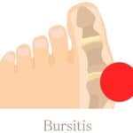 Bursitis