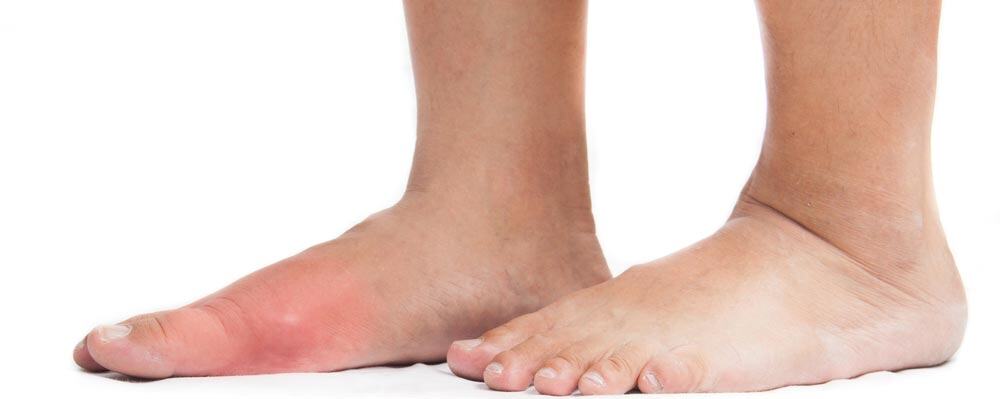 gout inflamation