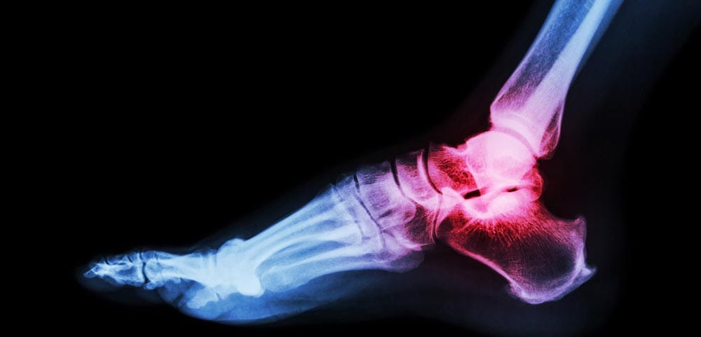 Ankle Cartilage Replacement