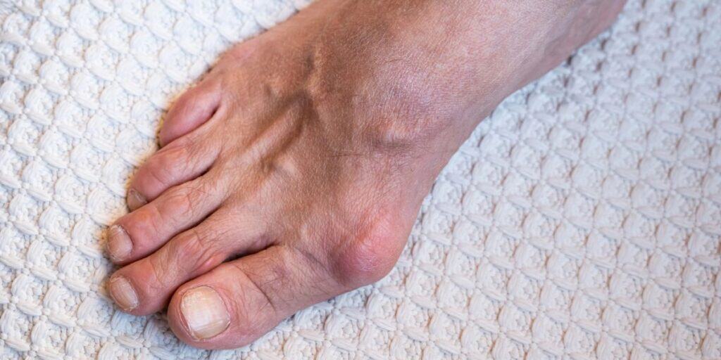 Select Bunions vs. Big Toe Arthritis, What’s the Difference? Bunions vs. Big Toe Arthritis, What’s the Difference?