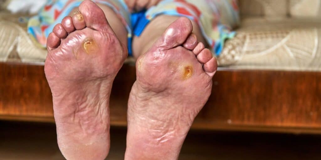 Diabetic Foot Conditions Osteomyelitis