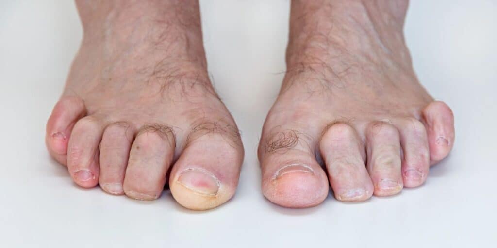 Hammertoe or Plantar Plate Injury: What’s the Difference?