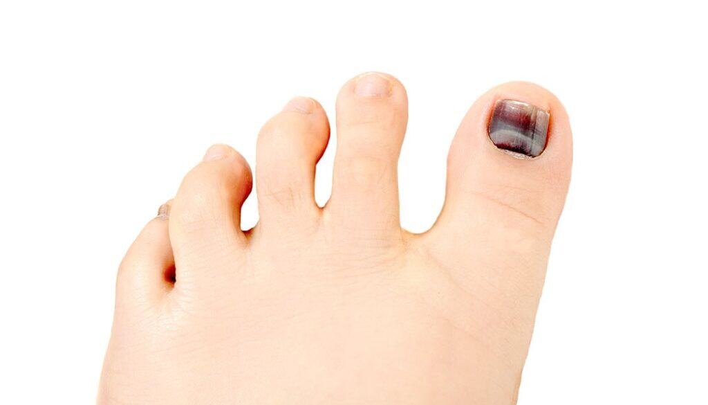 Foot with a black toenail, highlighting potential foot condition related to toenail health.