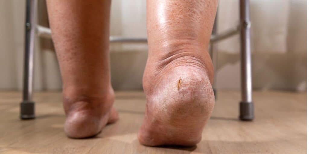 Neuropathy and Nerve Compression: Causes, Symptoms and Treatment