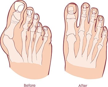 Before and After Bunion Surgery