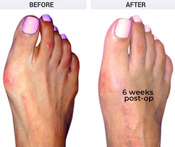 Forever Bunionectomy before and after image