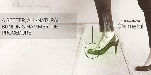 Woman wearing high heels, highlighting a better all-natural bunion and hammertoe procedure, emphasizing 100% restoration with 0% metal.