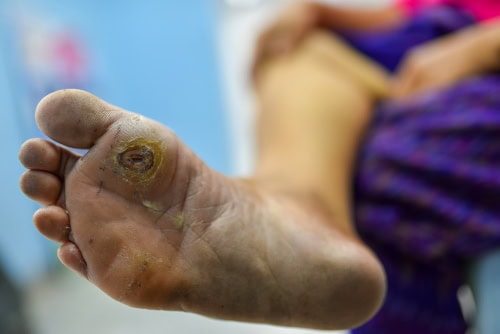 Diabetic foot ulcer