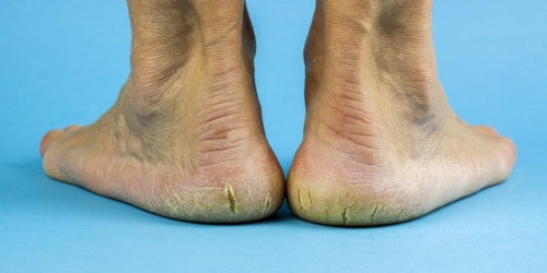Dry cracked heels