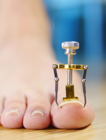 Infected Ingrown Toenail