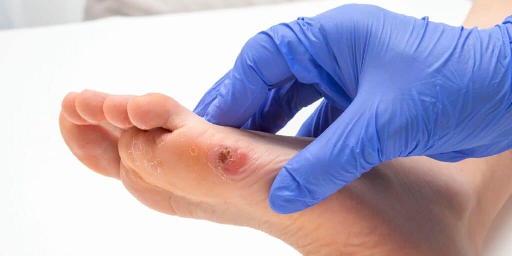 tailor’s bunion